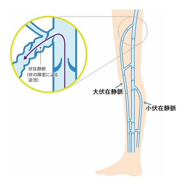 レーザー焼灼術