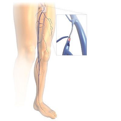 レーザー焼灼術
